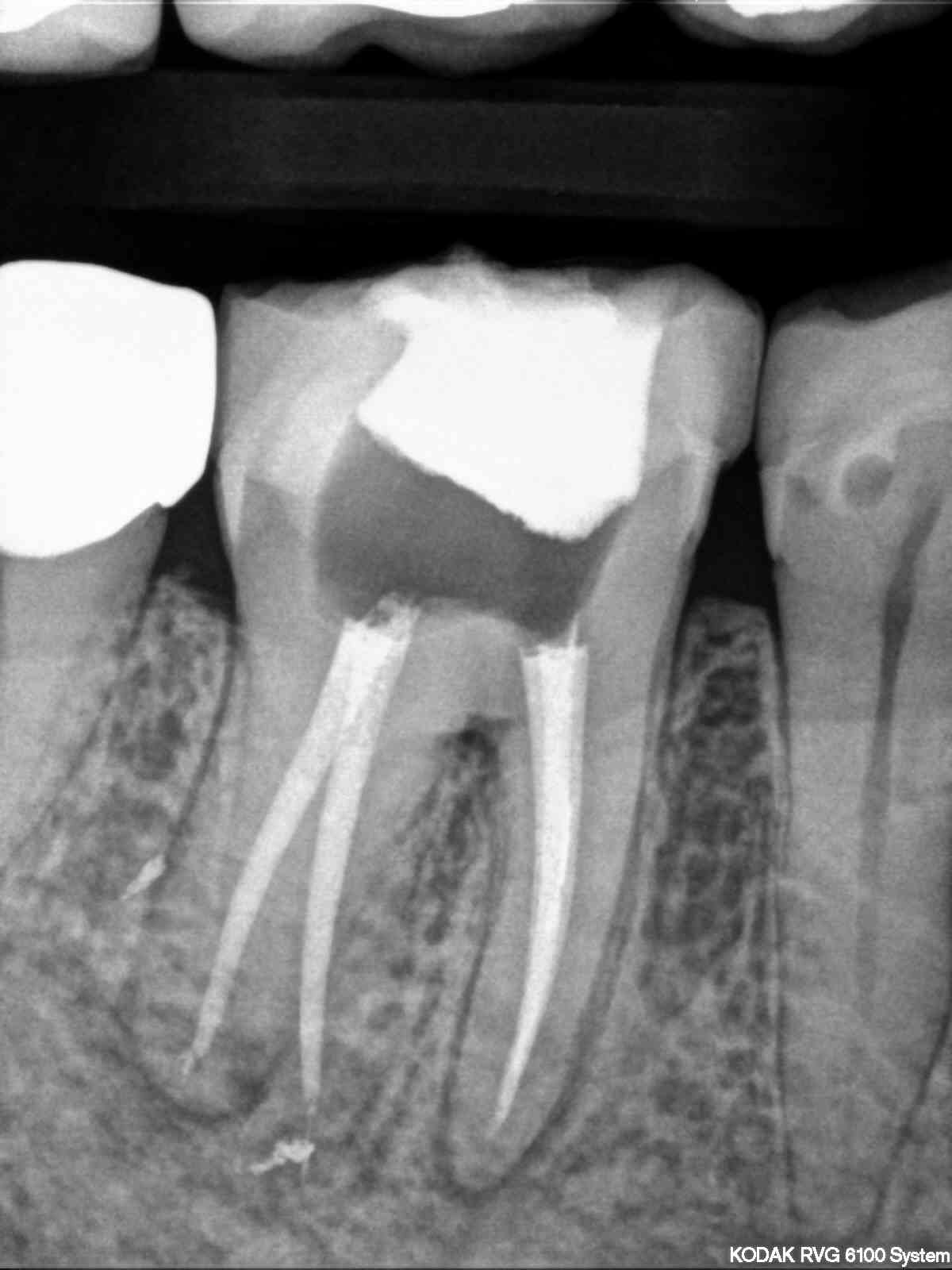 X-ray of tooth.
